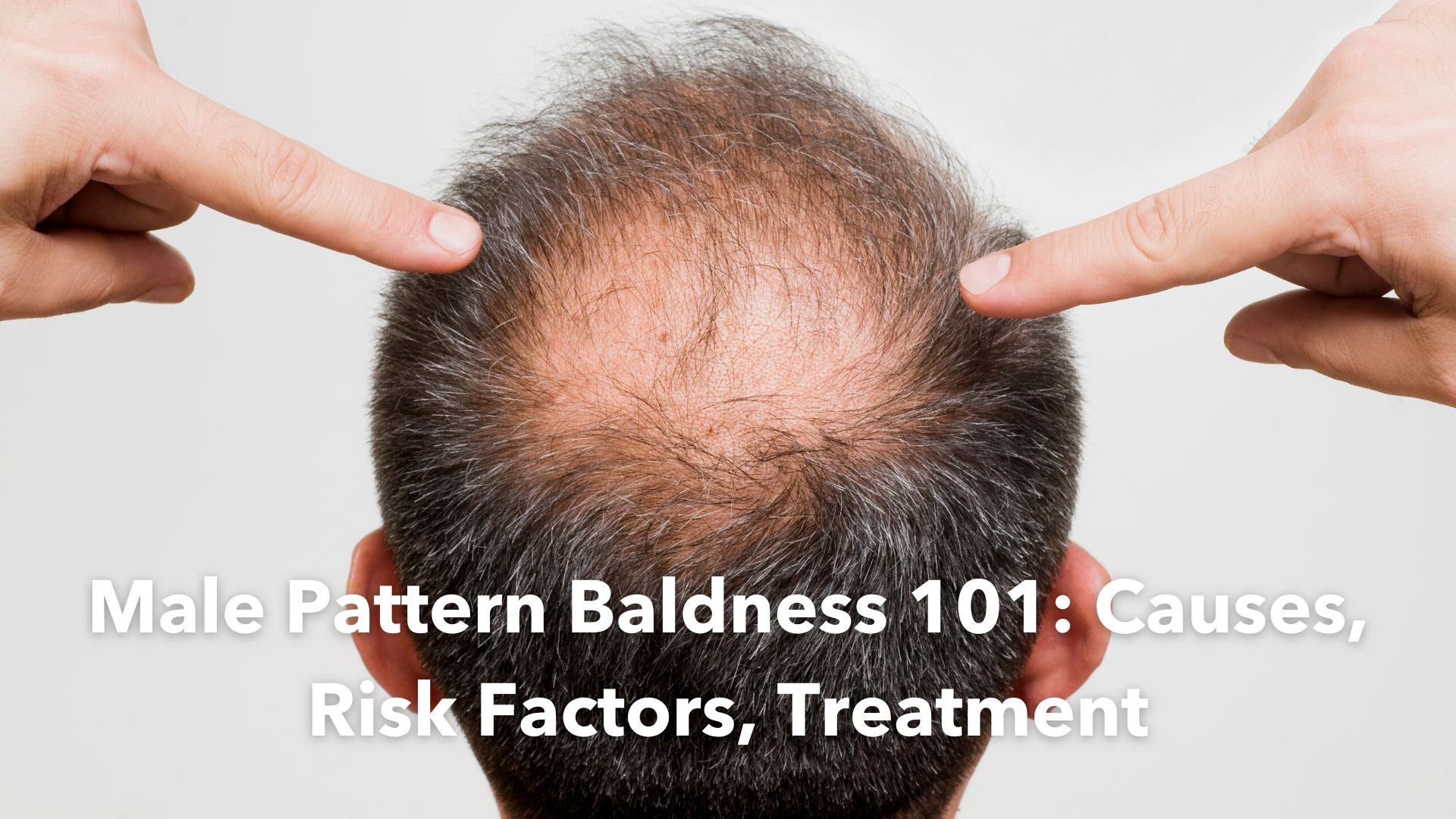 Horseshoe Pattern Baldness