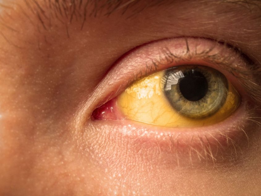 Yellow eyes caused by jaundice